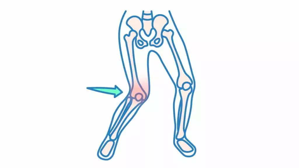 Illustration des Giving-Way-Syndroms – Knie knickt nach innen ein.